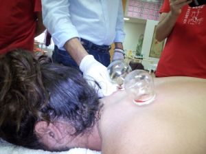 Ventosa de fuego-sangrias