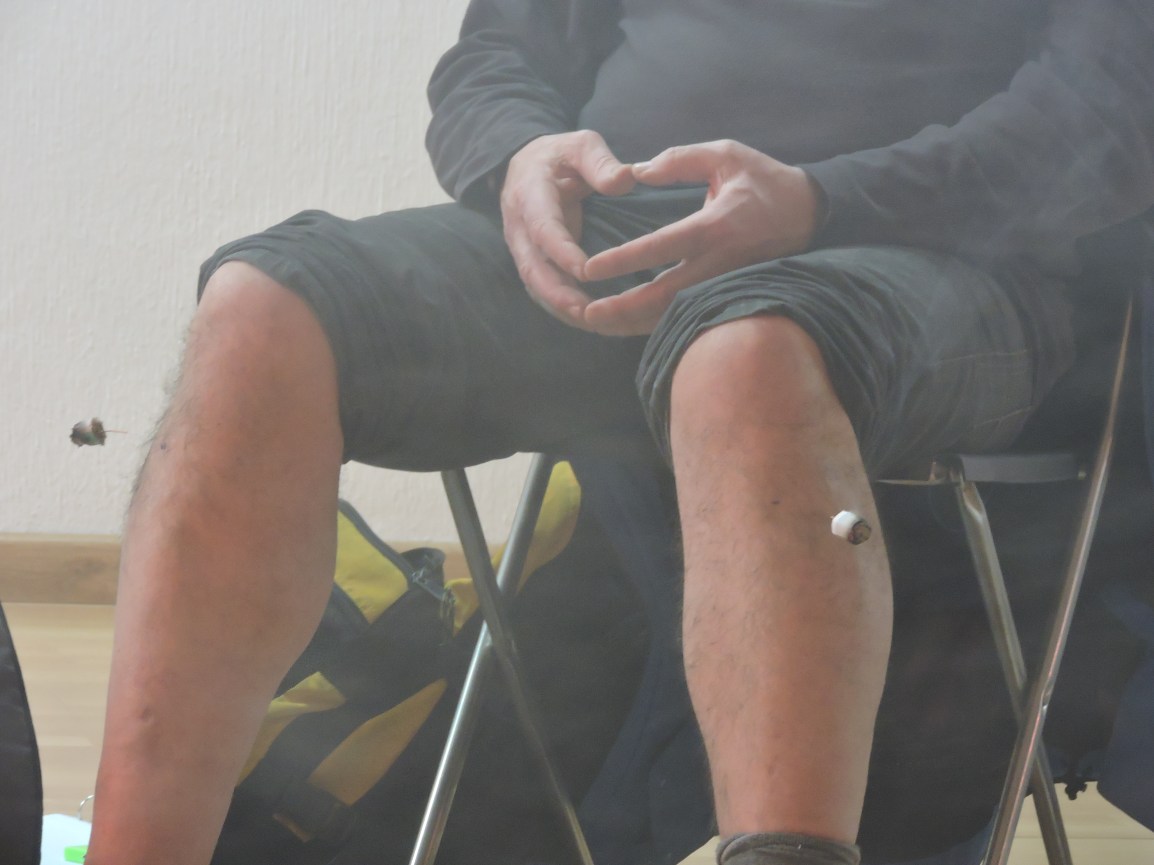 DISPEPSIA-ACUPUNTURA