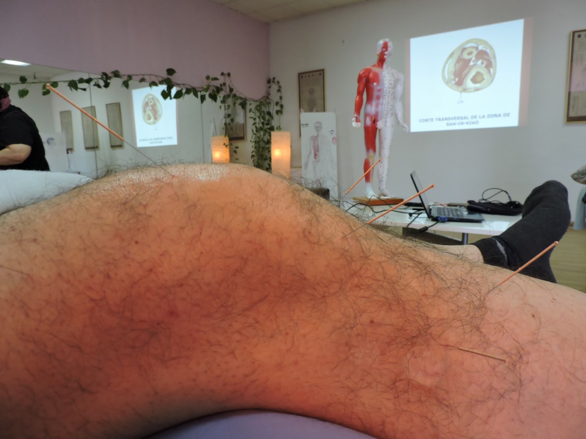 CONCENTRARSE Y ENFOCARSE CUANDO SE INSERTA LA&nbsp;AGUJA